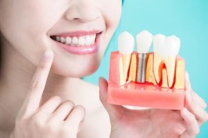 what to expect with dental implants