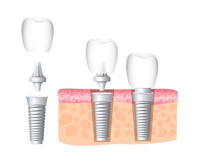 faqs of dental implants
