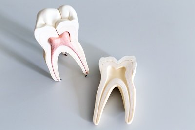 reasons for root canal therapy