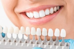 The Difference Between Traditional and No-Prep Veneers