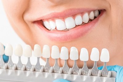 The Difference Between Traditional and No-Prep Veneers