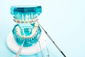 rubber bands for braces: helpful tips and tricks