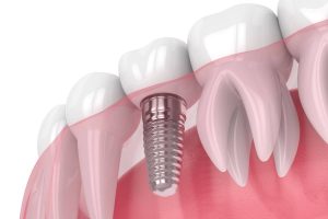 Why patients with tooth loss choose dental implants