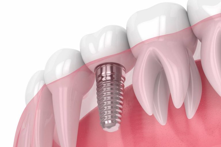 Why patients with tooth loss choose dental implants